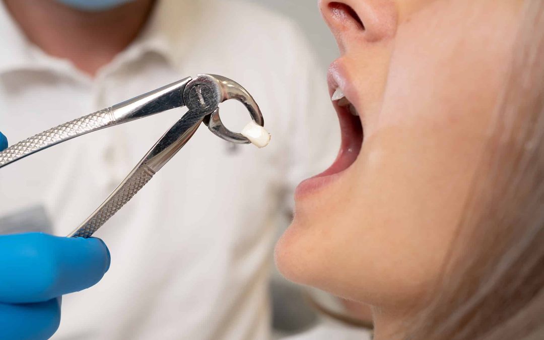 Will an Emergency Dentist Extract a Tooth?
